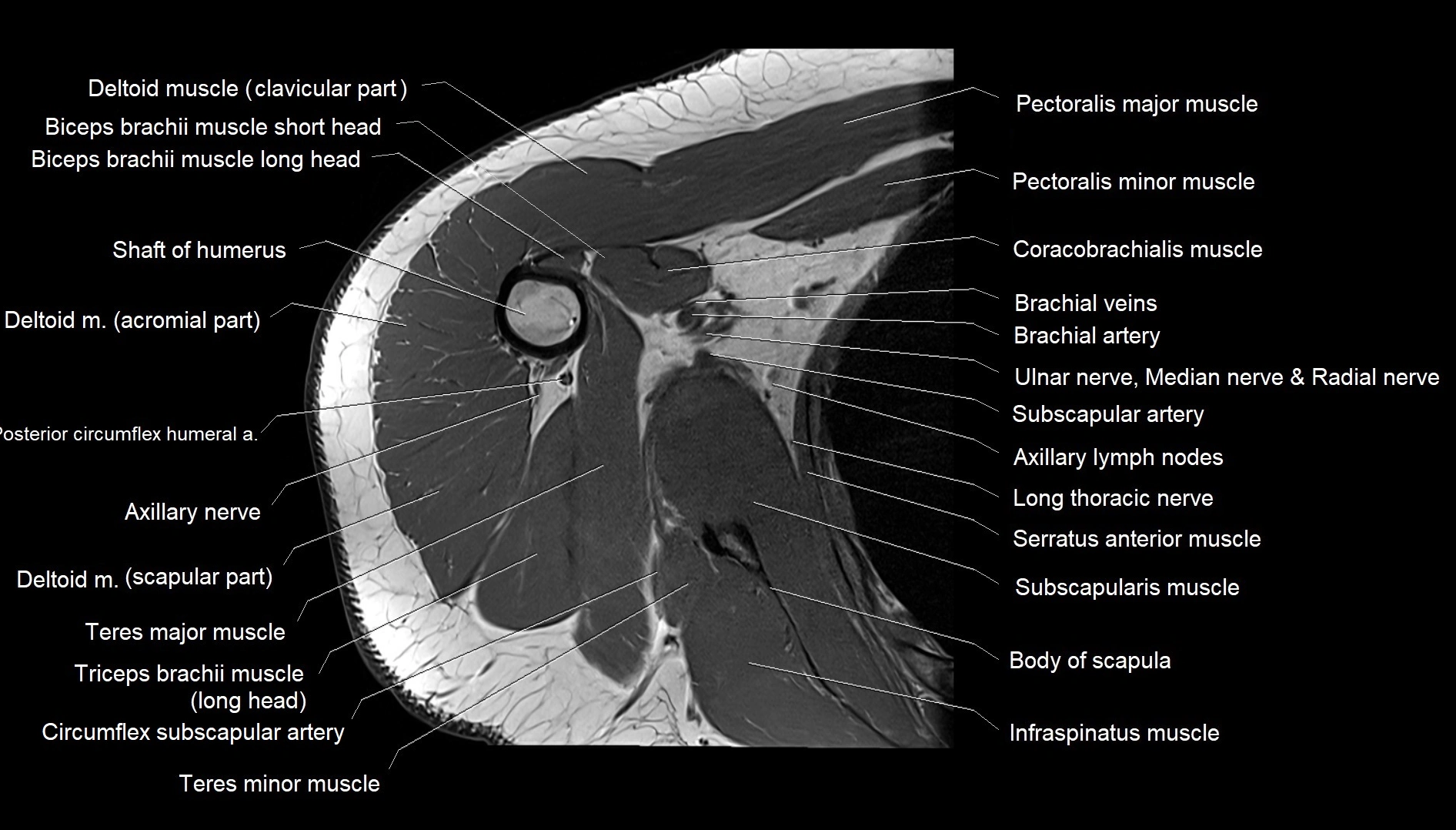 Shoulder cross sectional anatomy MRI 3T axial image 34.webp